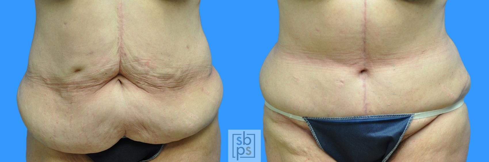 Before & After After Massive Weight Loss Case 89 View #4 View in Torrance, CA