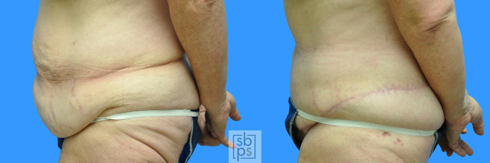 Before & After After Massive Weight Loss Case 89 View #5 View in Torrance & Los Angeles, CA, CA