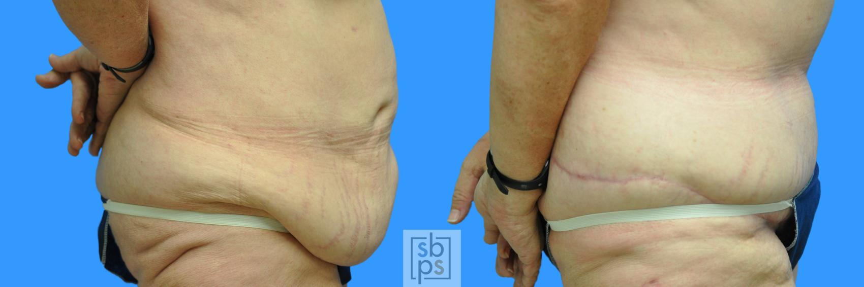Before & After After Massive Weight Loss Case 89 View #6 View in Torrance & Los Angeles, CA, CA
