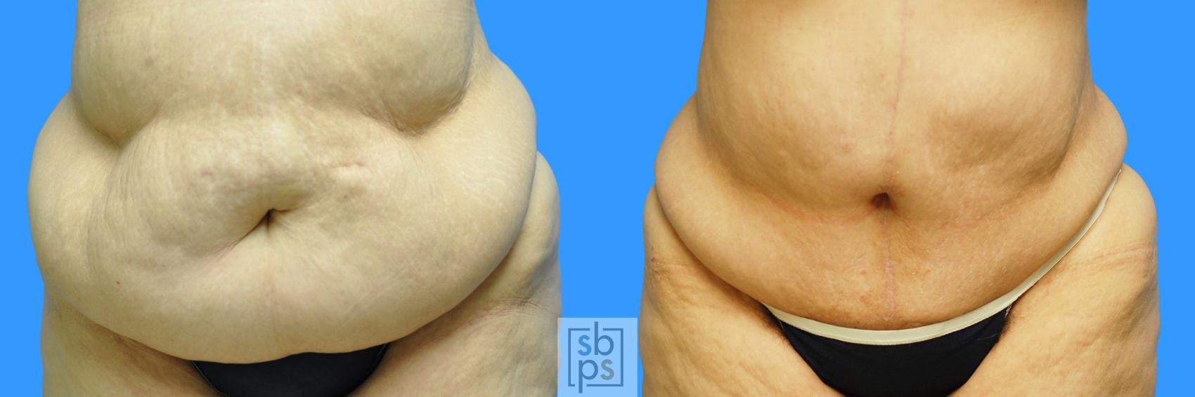 Before & After After Massive Weight Loss Case 95 View #6 View in Torrance, CA