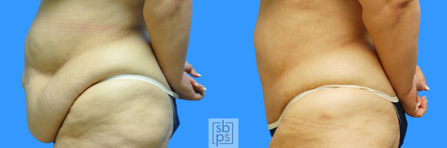 Before & After After Massive Weight Loss Case 95 View #7 View in Torrance & Los Angeles, CA, CA