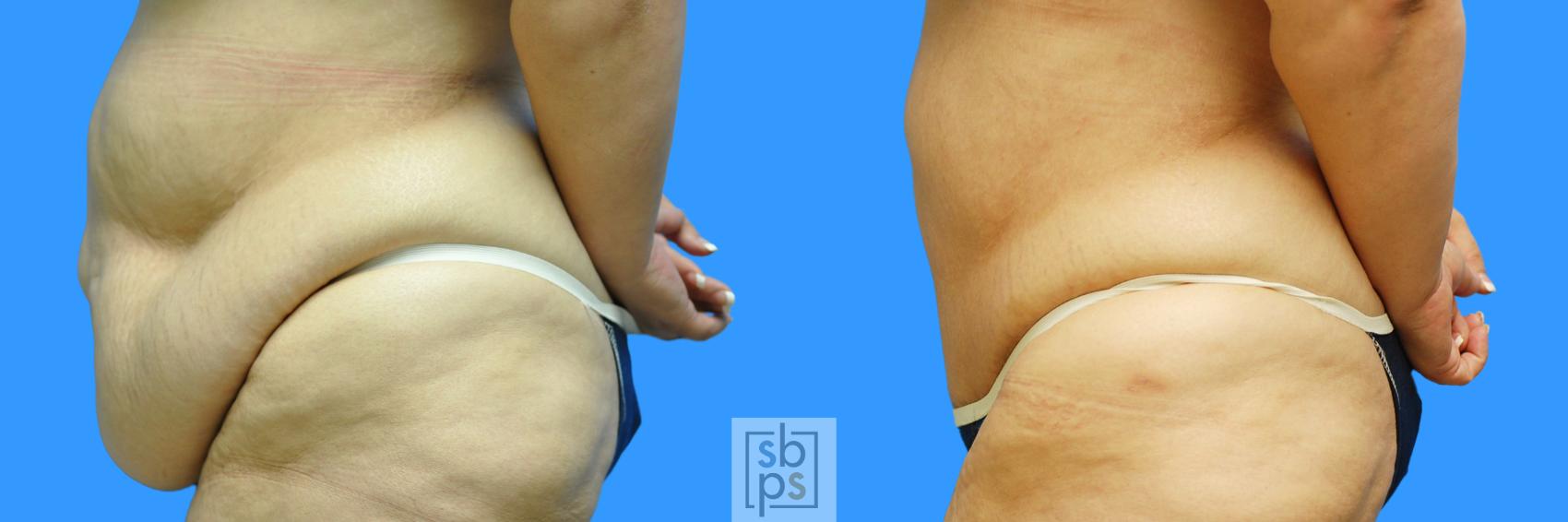 Before & After After Massive Weight Loss Case 95 View #8 View in Torrance & Los Angeles, CA, CA
