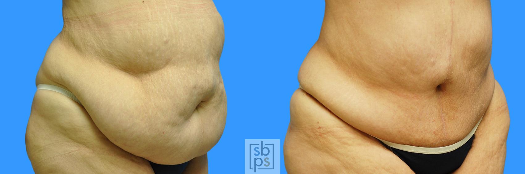 Before & After After Massive Weight Loss Case 95 View #9 View in Torrance & Los Angeles, CA, CA