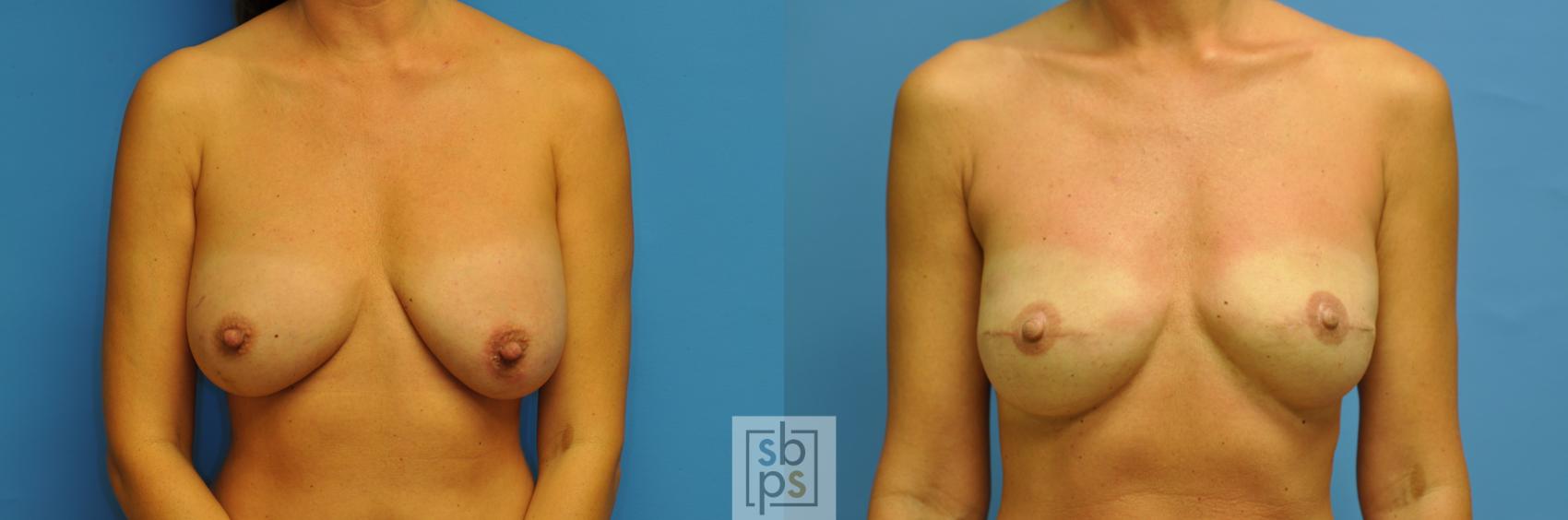Before & After Breast Reconstruction Case 162 View #1 View in Torrance, CA