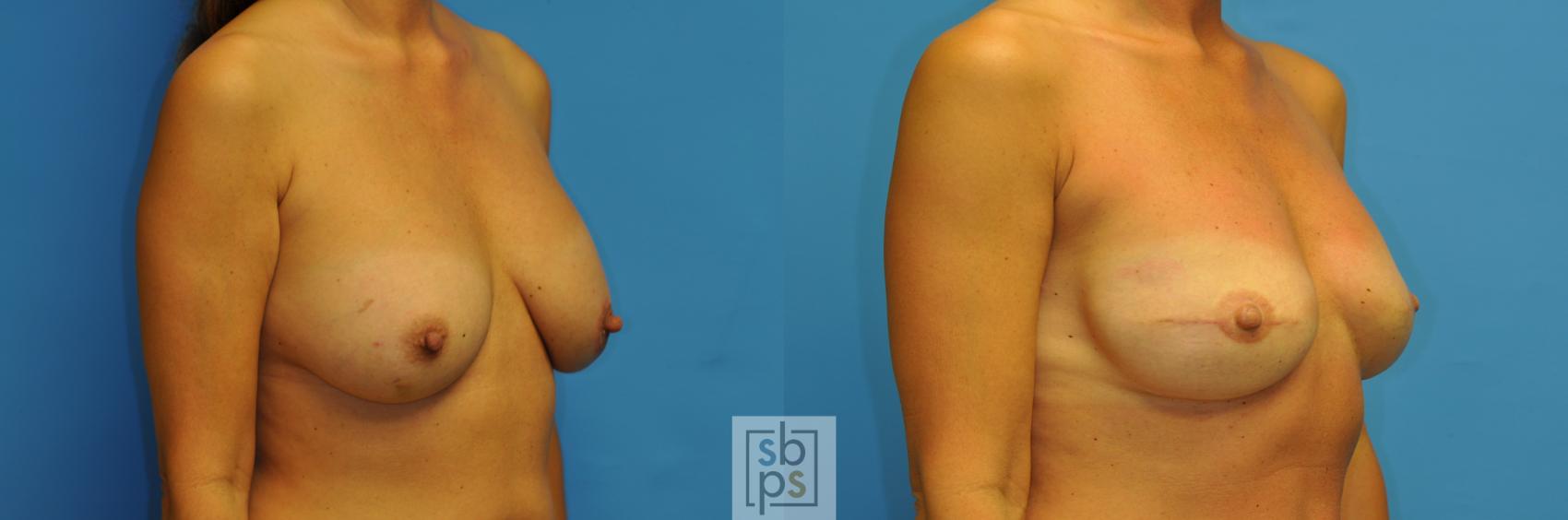 Before & After Breast Reconstruction Case 162 View #2 View in Torrance, CA