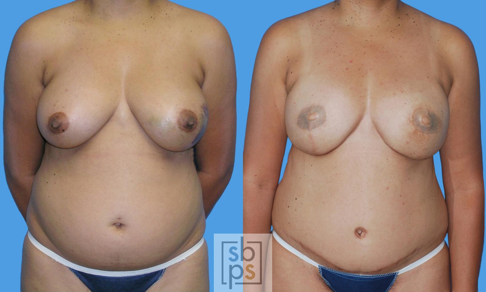Before & After Breast Reconstruction Case 178 View #1 View in Torrance, CA