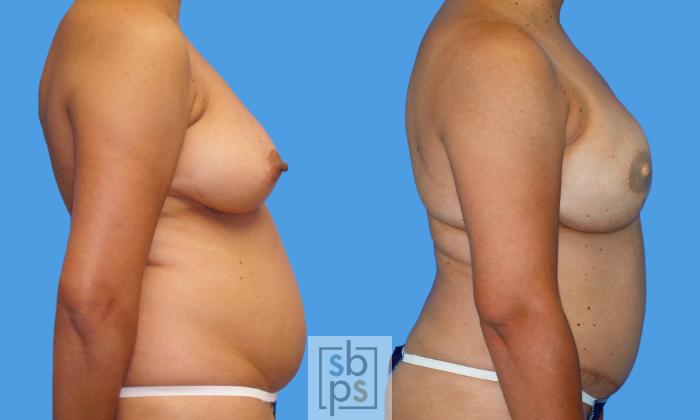Before & After Nipple Reconstruction Case 178 View #2 View in Torrance, CA