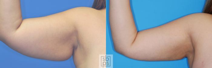 Before & After Liposuction Case 153 View #1 View in Torrance, CA