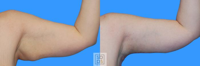 Before & After Arm Lift Case 221 View #1 View in Torrance, CA