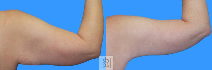 Before & After Arm Lift Case 221 View #2 View in Torrance, CA