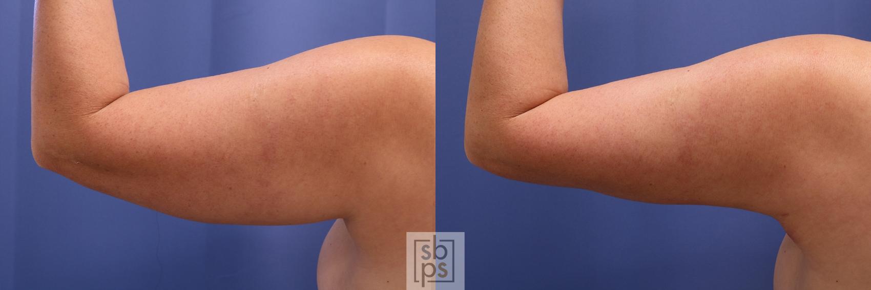 Before & After Arm Lift Case 470 Back Left View in Torrance, CA
