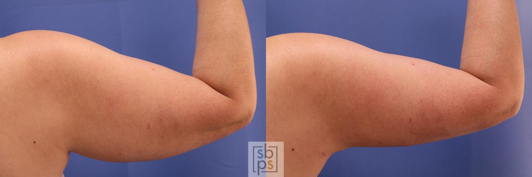 Before & After Arm Lift Case 470 Back Right  View in Torrance, CA