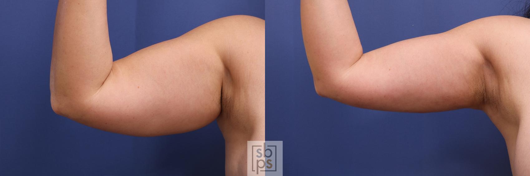 Before & After Arm Lift Case 470 Front View in Torrance, CA