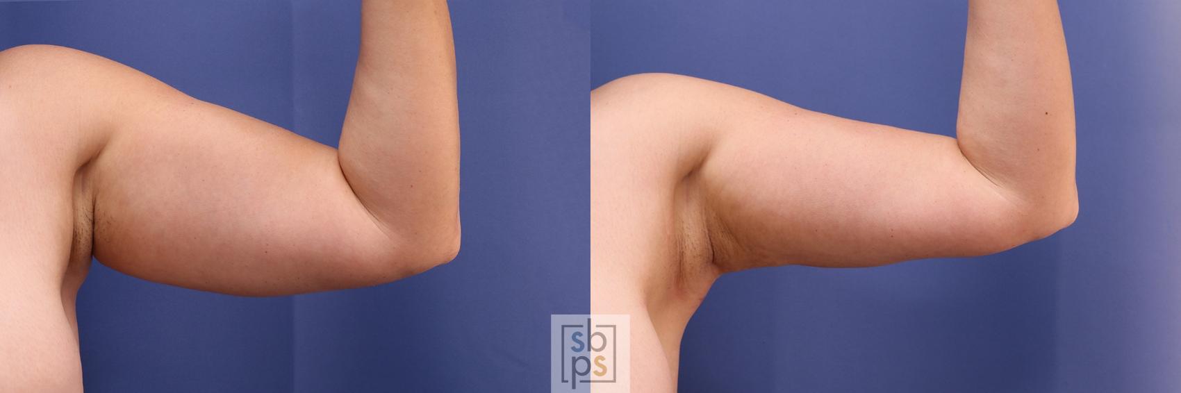 Before & After Arm Lift Case 470 Front Right View in Torrance, CA