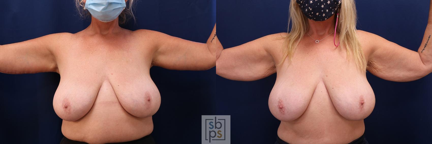 Before & After Arm Lift Case 577 Front View in Torrance, CA