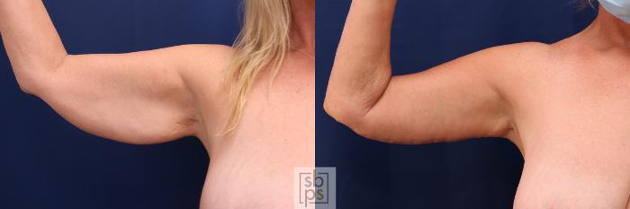 Before & After Arm Lift Case 577 Front Left View in Torrance, CA