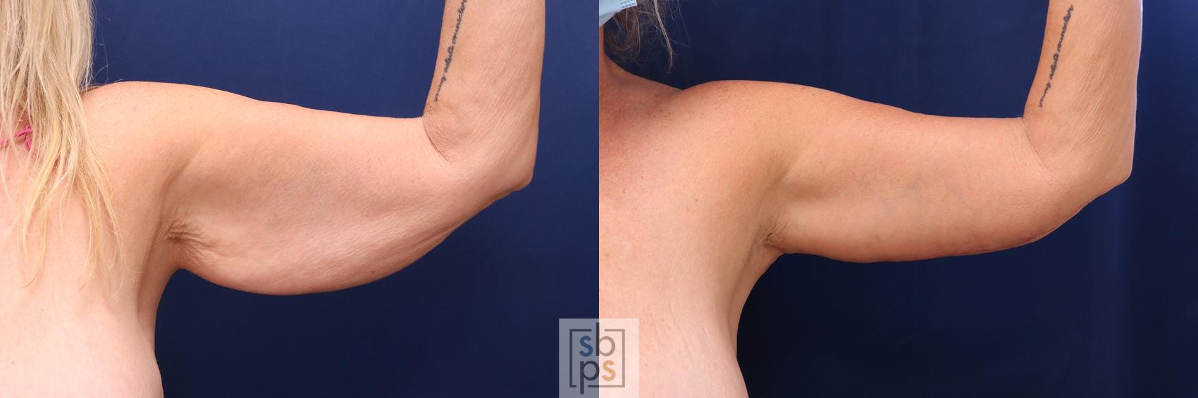 Before & After Arm Lift Case 577 Front Right View in Torrance, CA