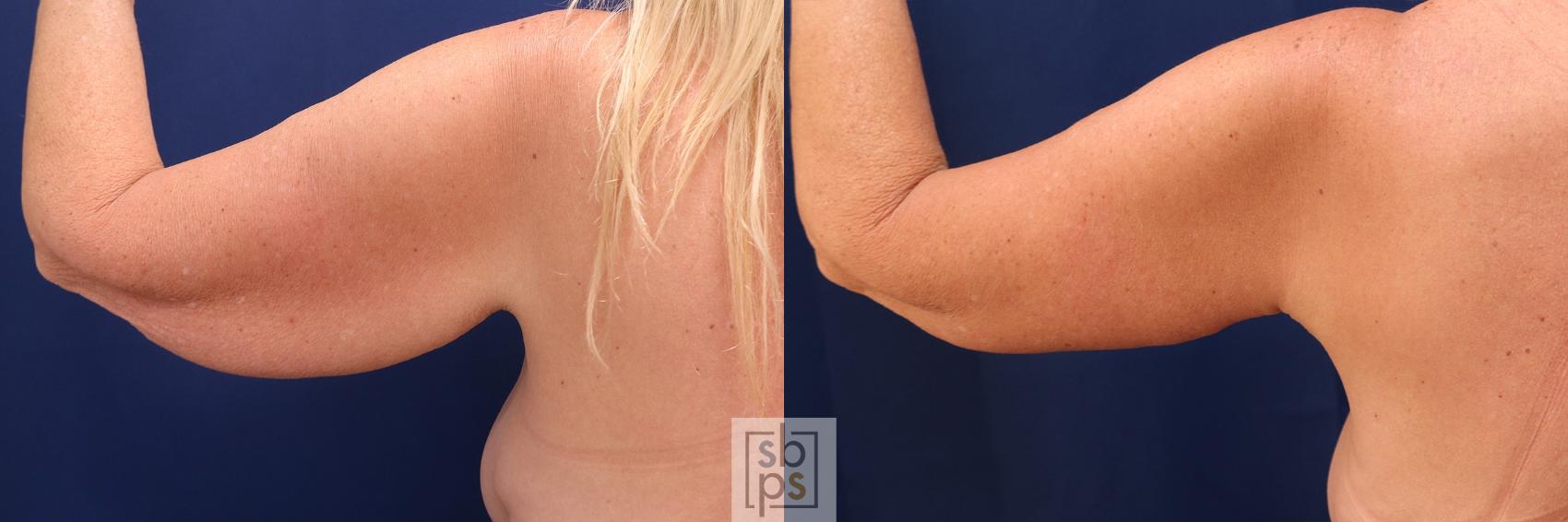 Before & After Arm Lift Case 577 Left Side View in Torrance, CA