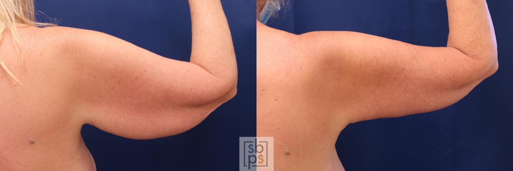 Before & After Arm Lift Case 577 Right Side View in Torrance, CA