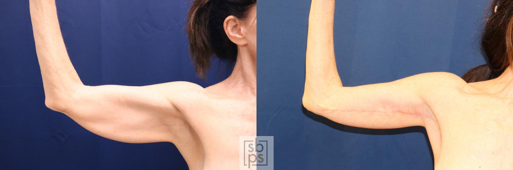 Before & After Arm Lift Case 699 Front Left View in Los Angeles, Torrance & Long Beach, CA