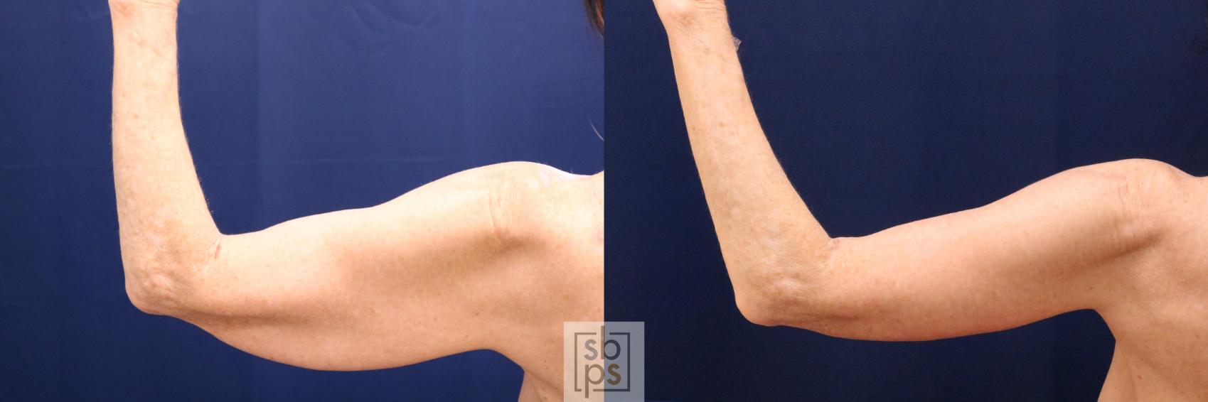 Before & After Arm Lift Case 699 Left Side View in Los Angeles & Torrance, CA, CA