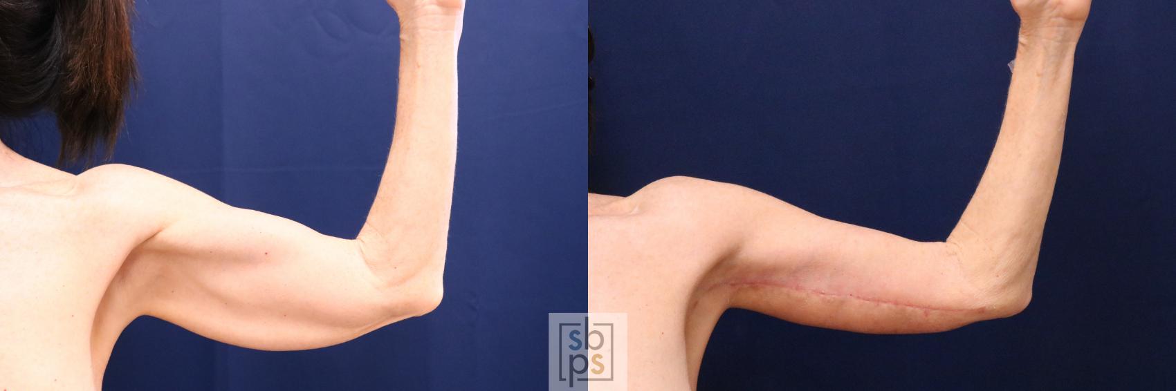 Before & After Arm Lift Case 699 Right Front View in Los Angeles, Torrance & Long Beach, CA