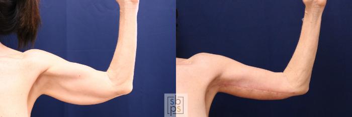 Before & After Arm Lift Case 699 Right Front View in Los Angeles & Torrance, CA, CA