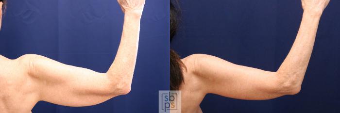 Before & After Arm Lift Case 699 Right Side View in Los Angeles & Torrance, CA, CA