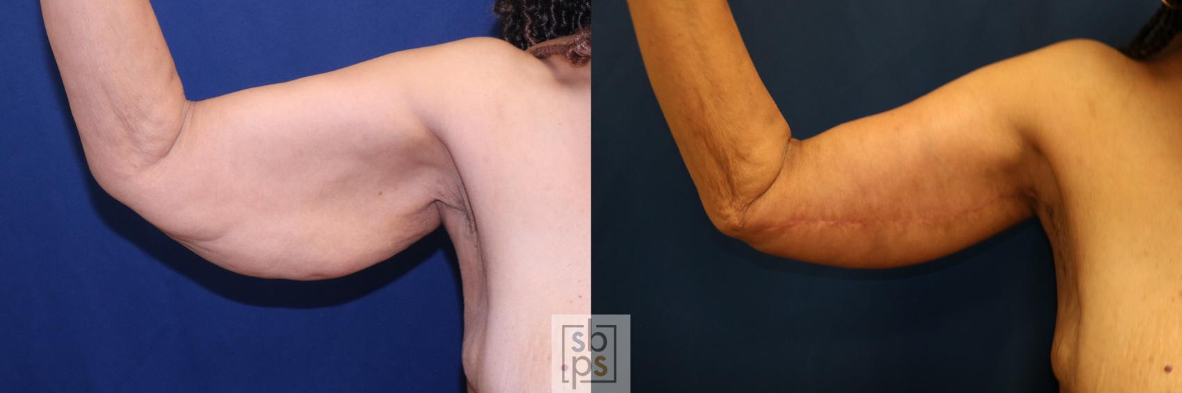 Before & After Arm Lift Case 733 Front Left View in Torrance & Los Angeles, CA, CA