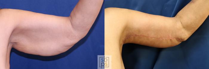 Before & After Arm Lift Case 733 Front Right View in Los Angeles & Torrance, CA, CA