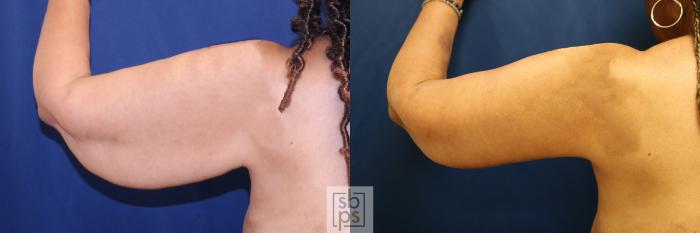 Before & After Arm Lift Case 733 Left Side View in Los Angeles & Torrance, CA, CA