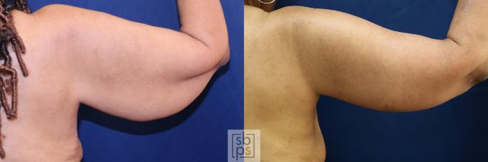 Before & After Arm Lift Case 733 Right Side View in Los Angeles & Torrance, CA, CA