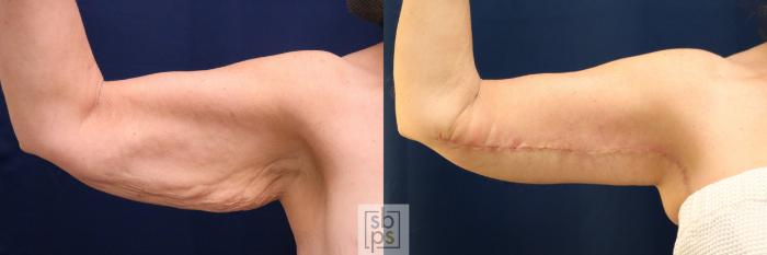 Before & After Arm Lift Case 748 Left Front View in Los Angeles, Torrance & Long Beach, CA