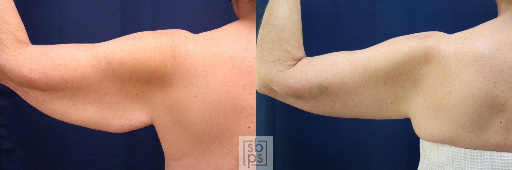 Before & After Arm Lift Case 748 Left Side View in Los Angeles, Torrance & Long Beach, CA