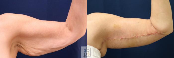 Before & After Arm Lift Case 748 Right Front View in Los Angeles, Torrance & Long Beach, CA