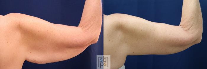 Before & After Arm Lift Case 748 Right Side View in Los Angeles, Torrance & Long Beach, CA