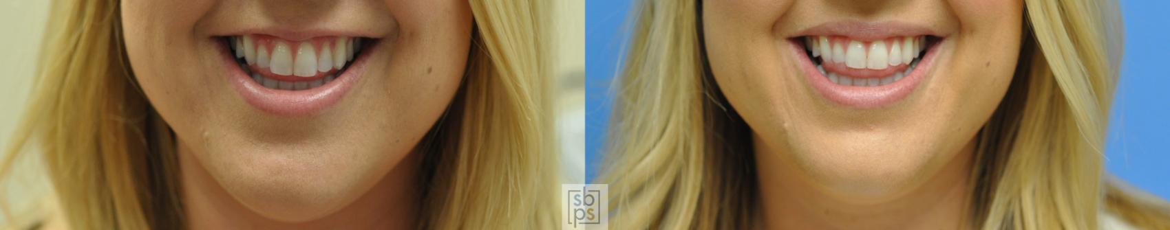 Before & After BOTOX® Cosmetic Case 150 View #1 View in Torrance, CA