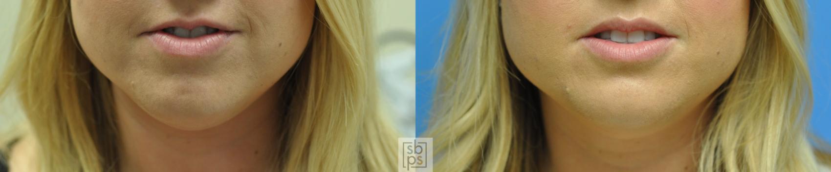 Before & After BOTOX® Cosmetic Case 150 View #2 View in Torrance & Los Angeles, CA, CA