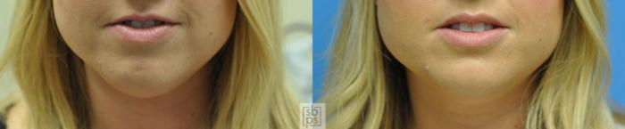 Before & After BOTOX® Cosmetic Case 150 View #2 View in Torrance, CA