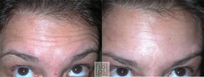 Before & After BOTOX® Cosmetic Case 23 View #1 View in Torrance, CA