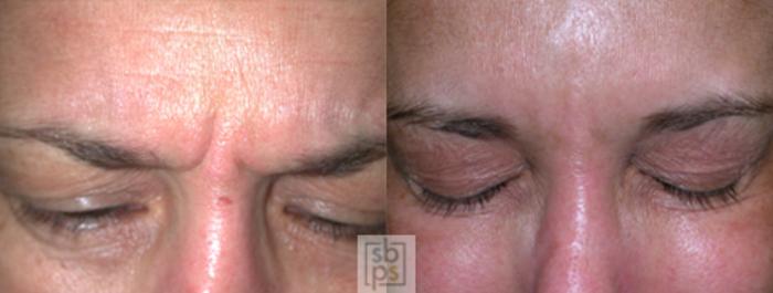 Before & After BOTOX® Cosmetic Case 24 View #1 View in Torrance, CA