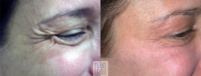 Before & After BOTOX® Cosmetic Case 25 View #1 View in Torrance, CA