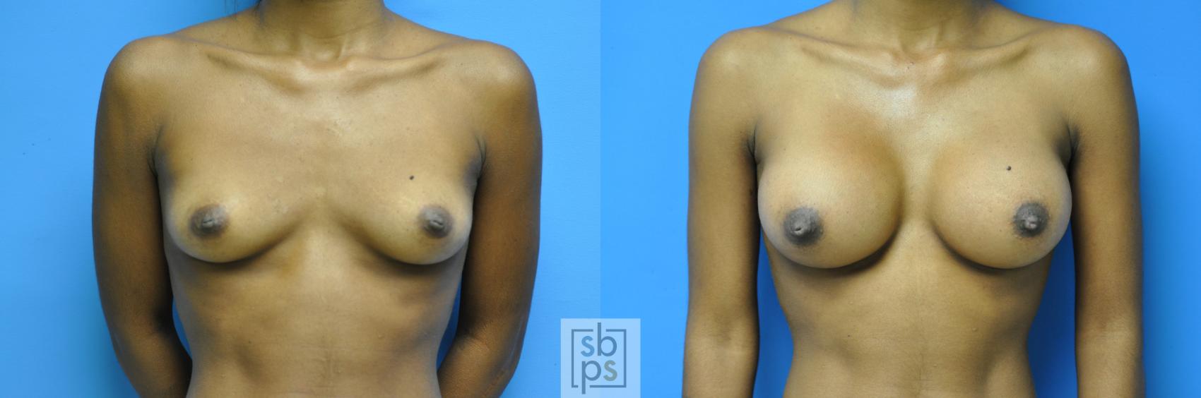 Before & After Breast Augmentation Case 102 View #1 View in Torrance, CA