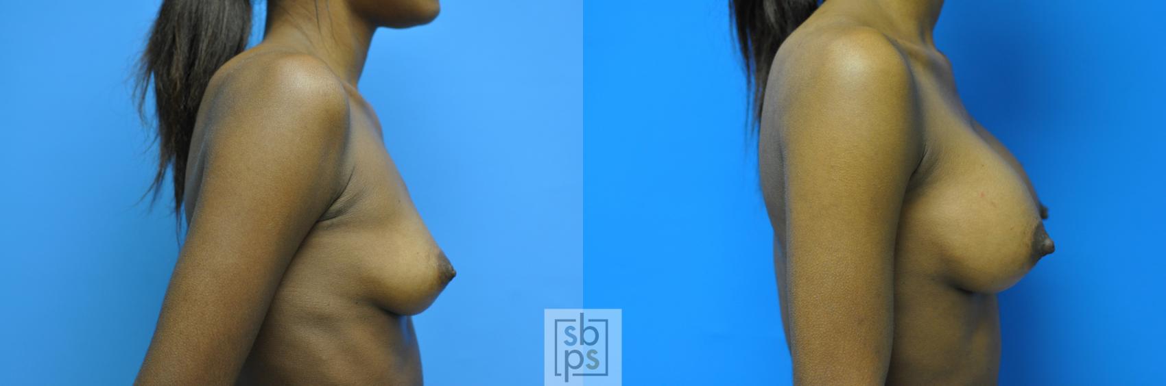 Before & After Breast Augmentation Case 102 View #2 View in Torrance & Los Angeles, CA, CA