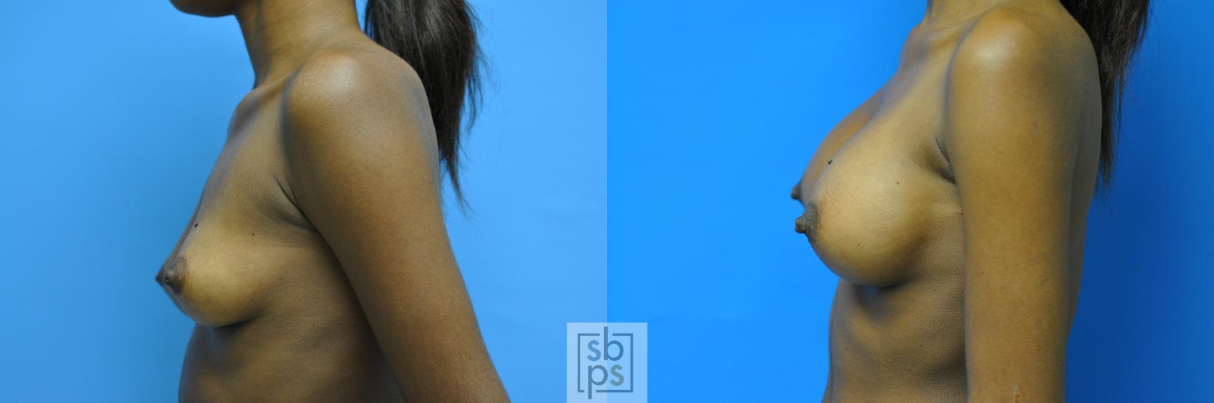 Before & After Breast Augmentation Case 102 View #3 View in Torrance & Los Angeles, CA, CA
