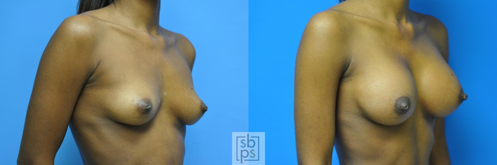 Before & After Breast Augmentation Case 102 View #4 View in Torrance & Los Angeles, CA, CA