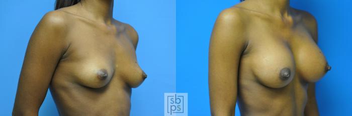 Before & After Breast Augmentation Case 102 View #4 View in Torrance, CA