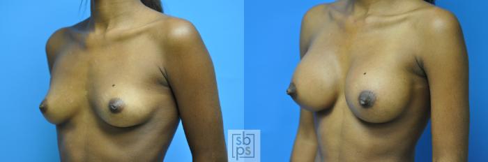 Before & After Breast Augmentation Case 102 View #5 View in Torrance, CA