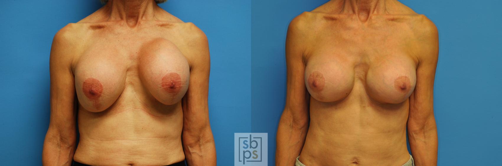 Before & After Breast Augmentation Case 103 View #1 View in Torrance, CA