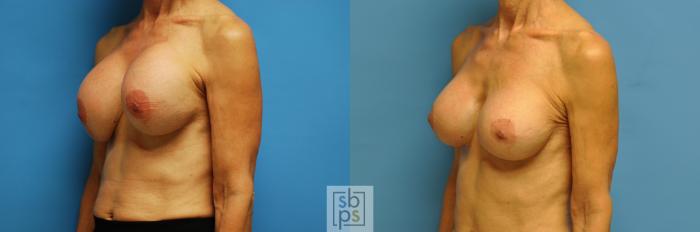 Before & After Breast Augmentation Case 103 View #2 View in Torrance, CA